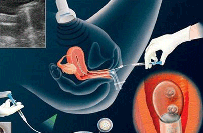 取卵子有什么危害