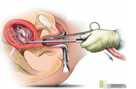 做药流的最佳时间
