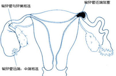 造影什么时候做最好
